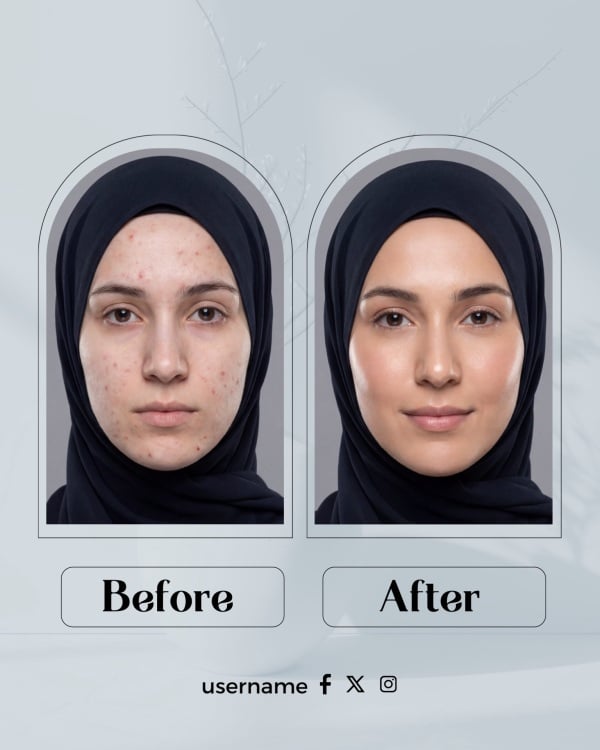Design Before and After for Skin Improvement, download and edit for free design template - Before and After from the Andalusi design app